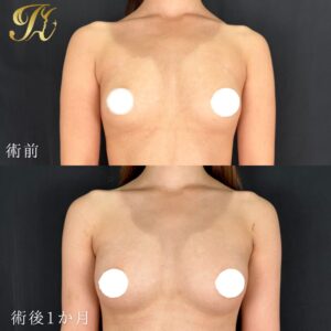 脂肪豊胸