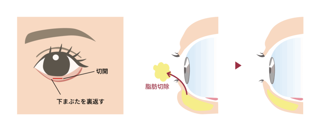 切らないクマ取りイメージ