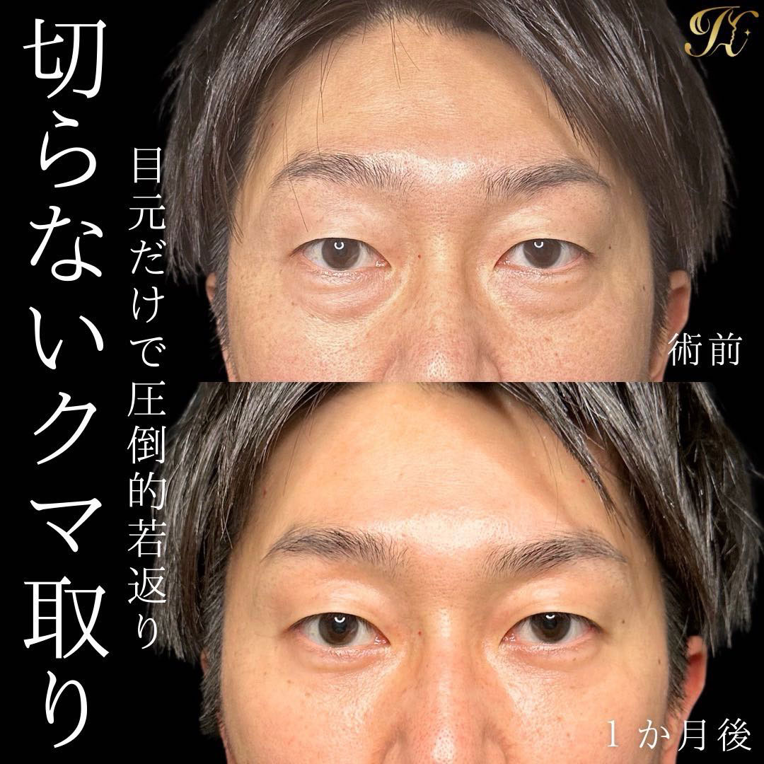 東岡崎美容クリニックのクマとり症例