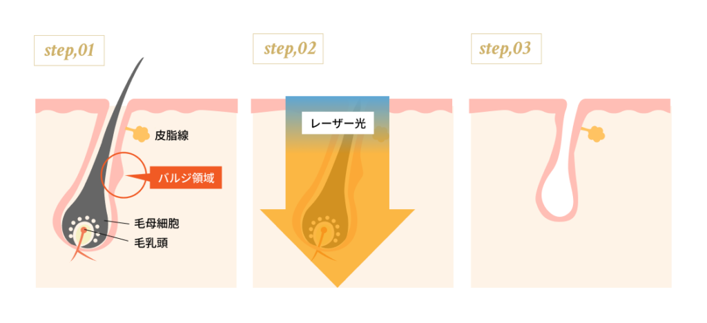 ジェントルマックスプロの効果イメージ
