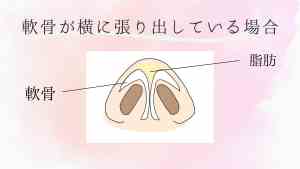 だんご鼻整形の方法-1