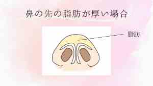 だんご鼻整形の方法-2