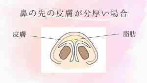 だんご鼻整形の方法-3