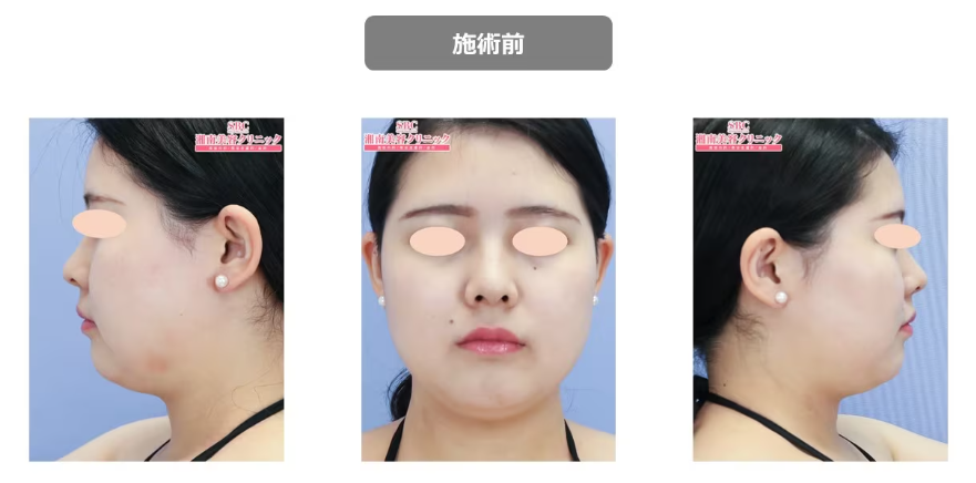 クルスカをやめるとどうなるの施術前症例写真