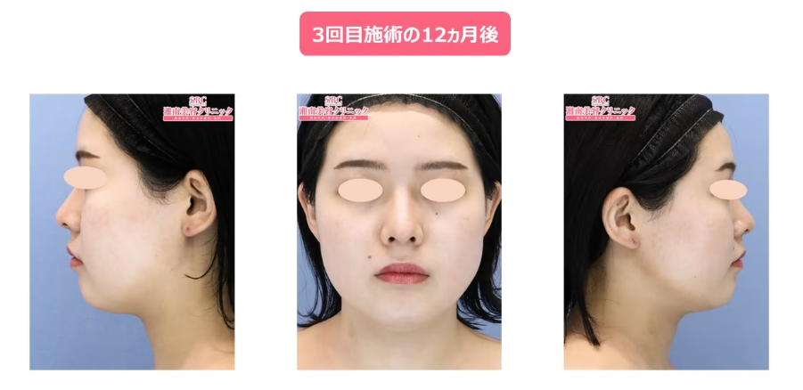 クルスカをやめるとどうなるの施術後症例写真