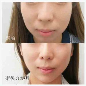 水の森美容クリニック-だんご鼻症例写真-2