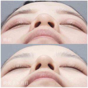 水の森美容クリニック-だんご鼻症例写真