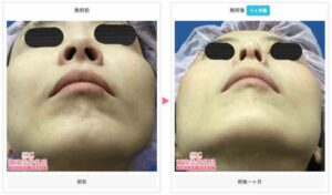 湘南美容クリニック-だんご鼻症例写真-2