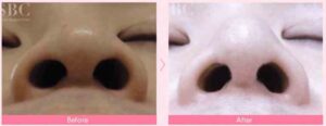 湘南美容クリニック-だんご鼻症例写真-4
