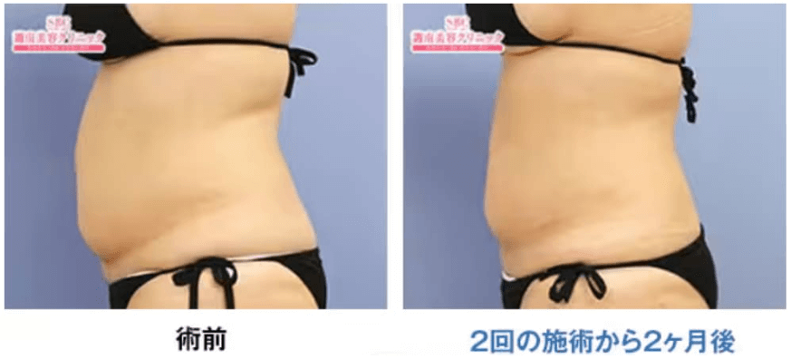 湘南美容クリニッククールスカルプティング症例写真