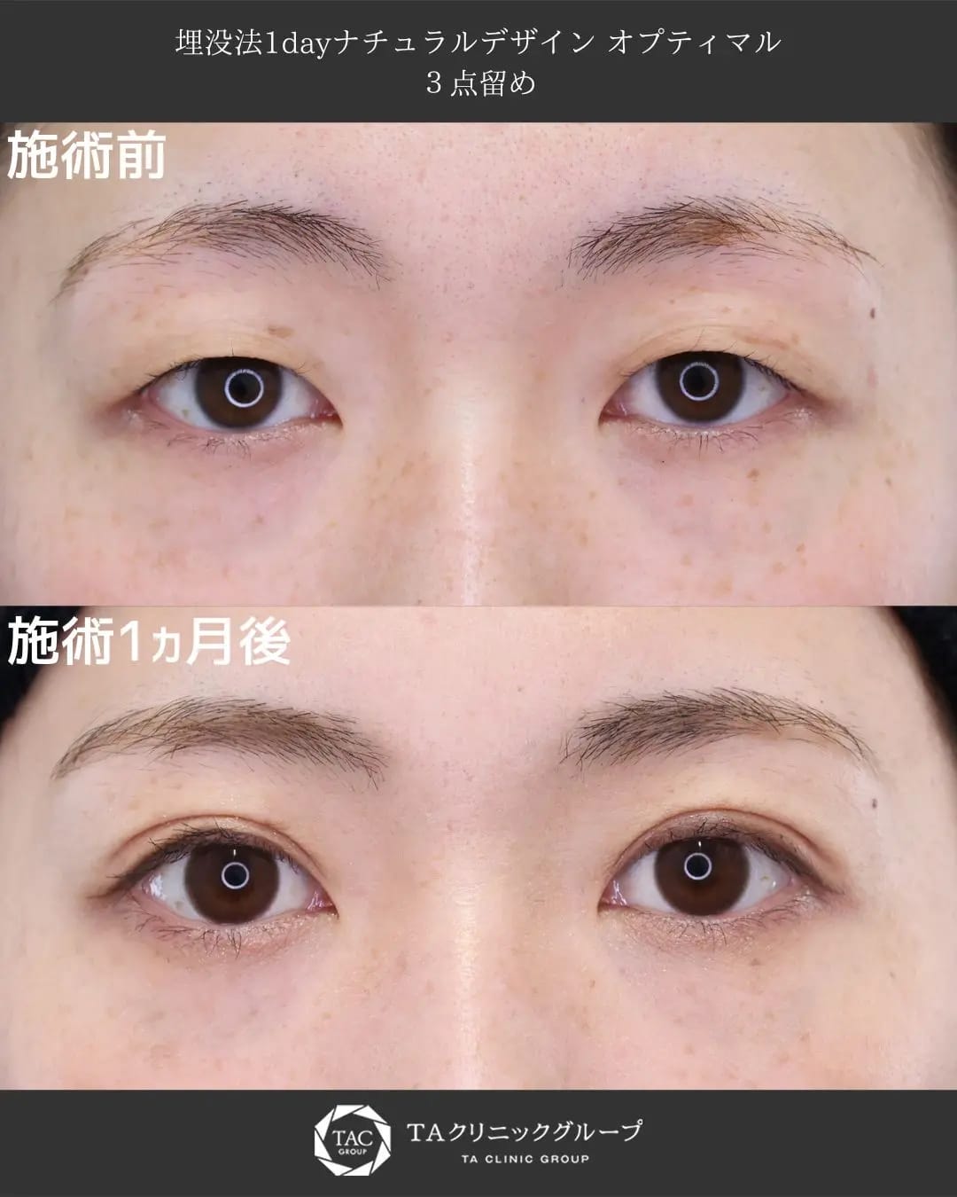 TAクリニックの二重整形症例写真-堂脇医師