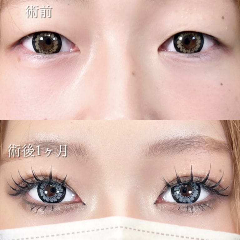 TCB東京中央美容外科の二重整形症例-川島医師