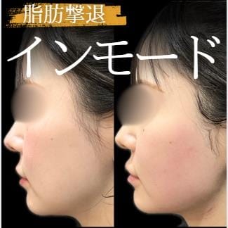 インモードVリフティング症例写真ルラ美容クリニック
