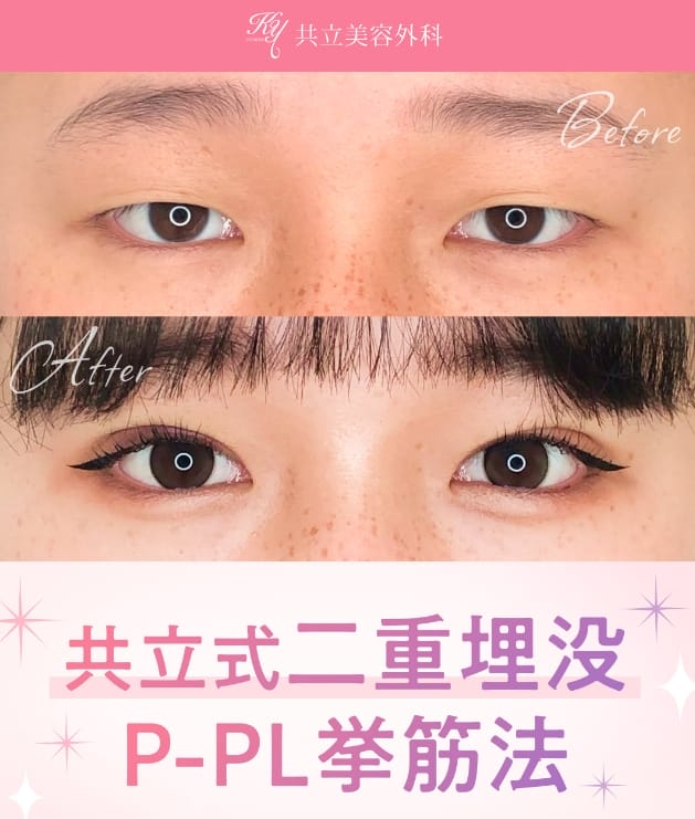 共立美容外科の二重整形ＦＶ