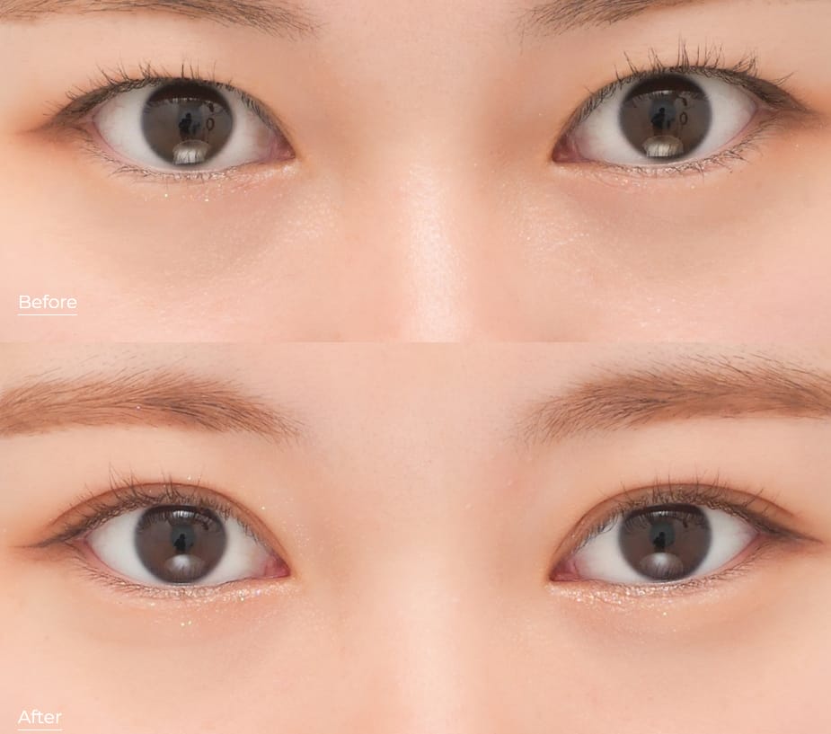 東京イセアクリニックの二重整形症例写真1