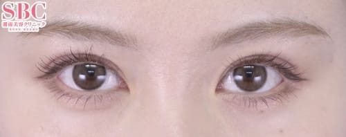湘南美容クリニック二重整形症例-金医師