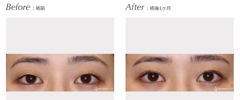 聖心美容クリニック-六本木院の二重整形症例写真