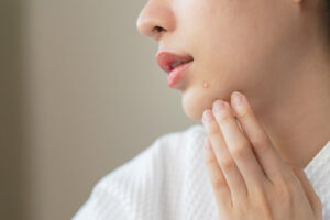 acne-img