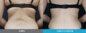 メディアージュクリニック-脂肪冷却症例写真