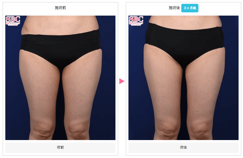 湘南美容クリニック-太ももクルスカ症例写真