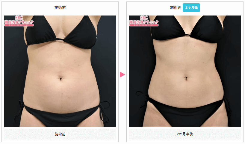 湘南美容クリニック-脂肪冷却症例写真