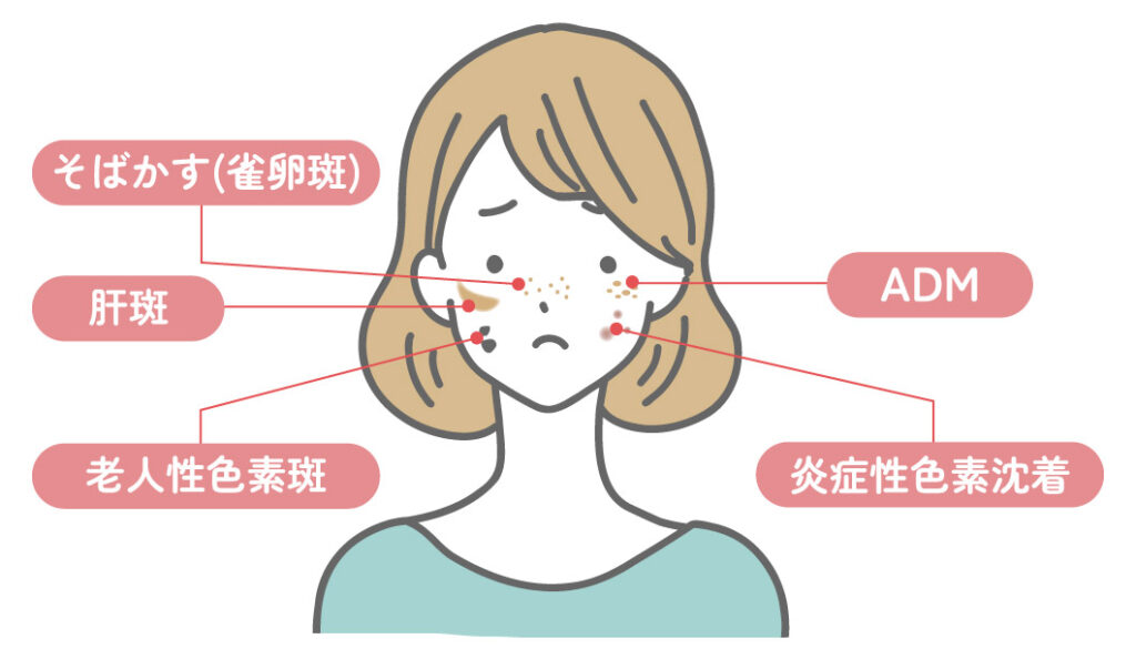 セルフケアでは限界があるシミの種類とは？