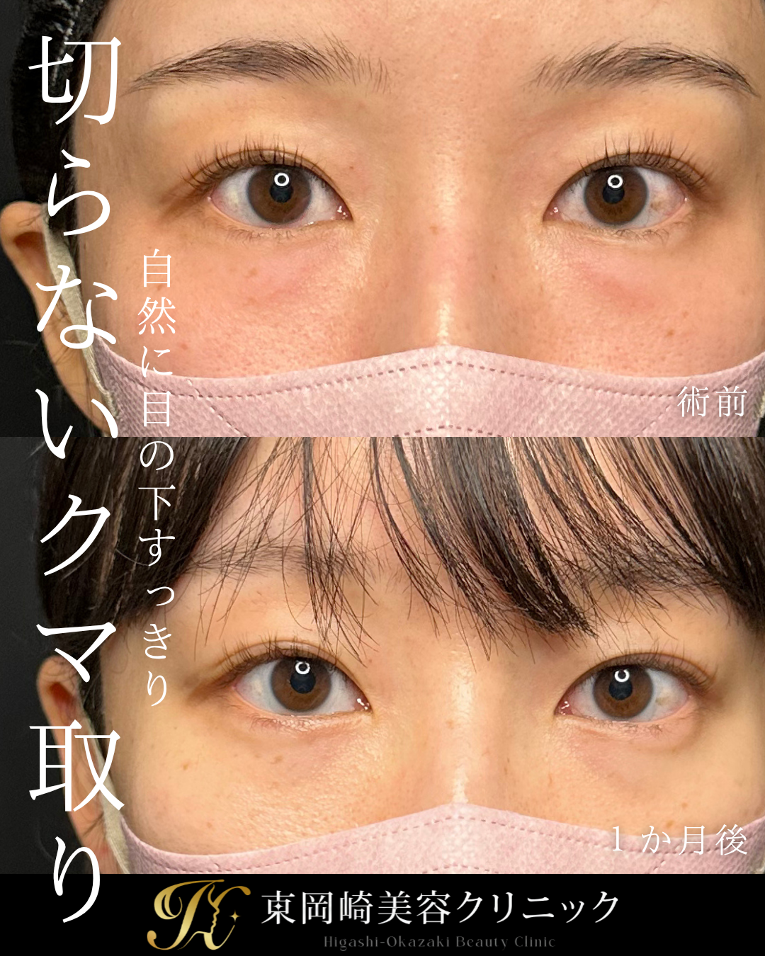 切らないクマ取り