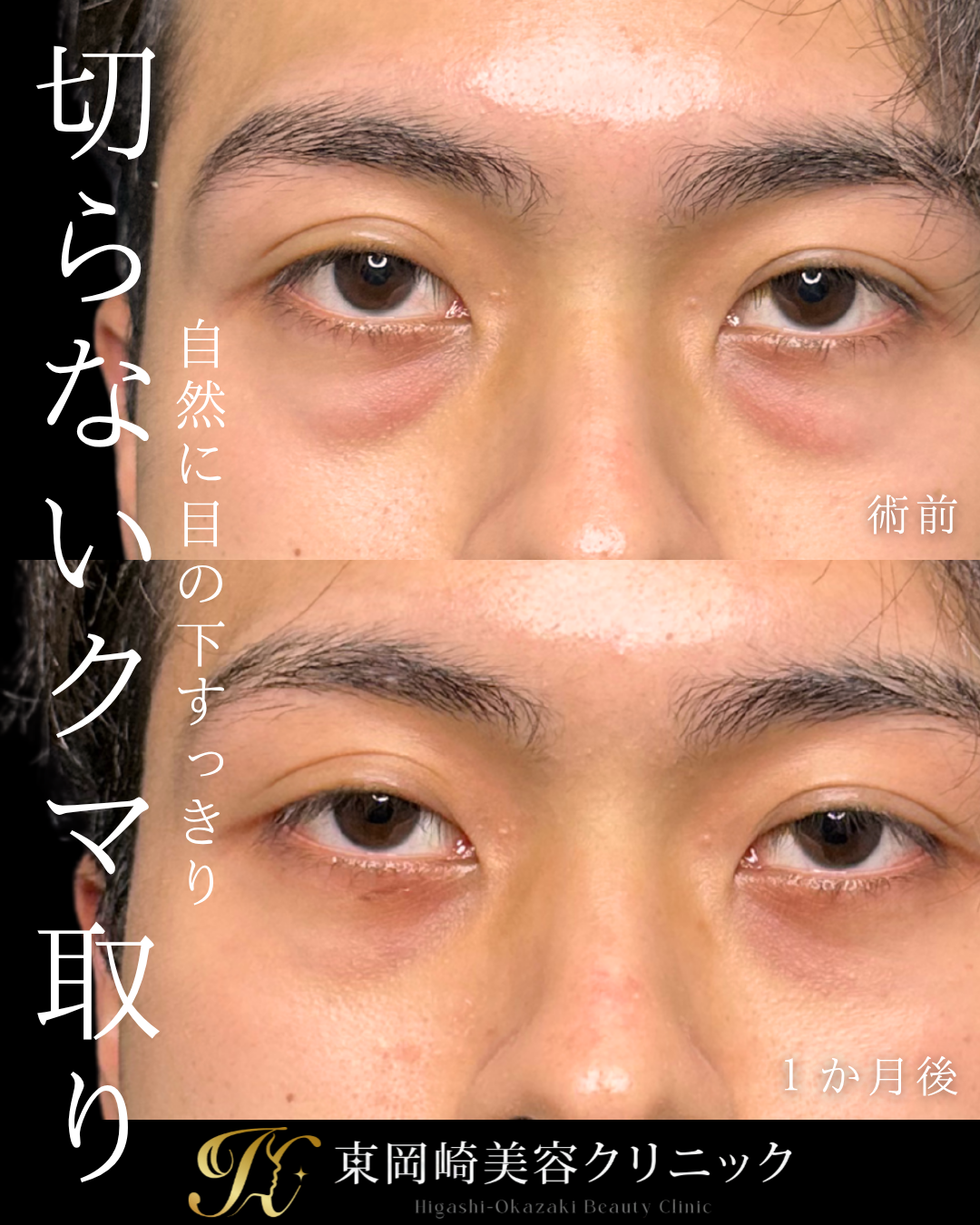 切らないクマ取り