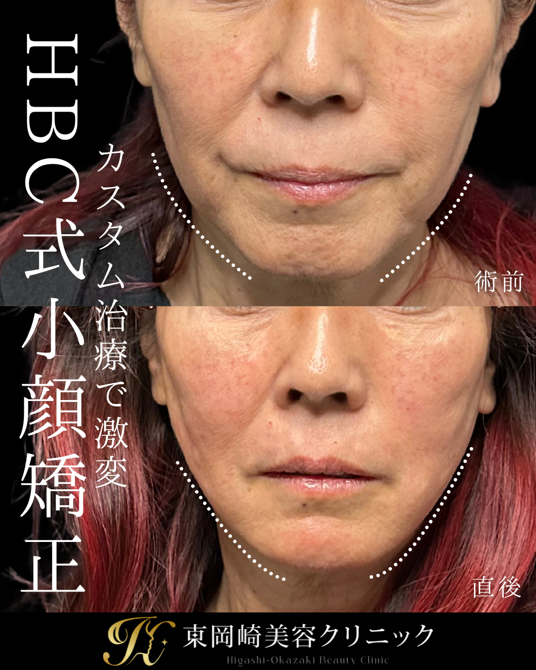 カスタム治療で若返り（糸リフト・ヒアルロン酸）