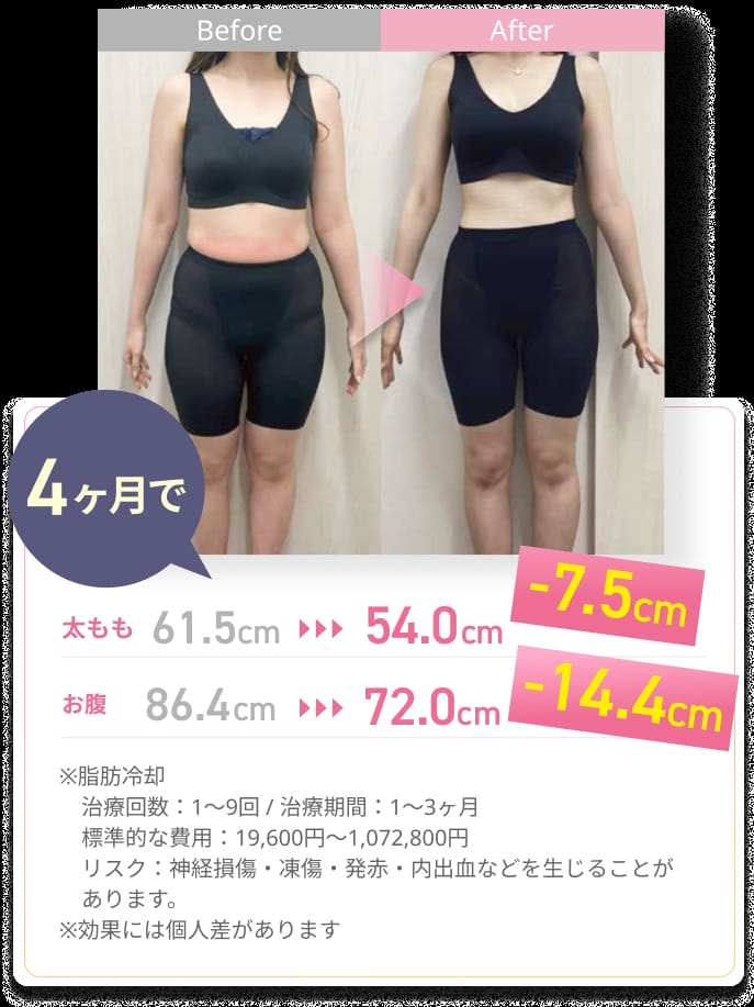 ジュノビューティークリニックの脂肪冷却の症例写真と詳細情報
