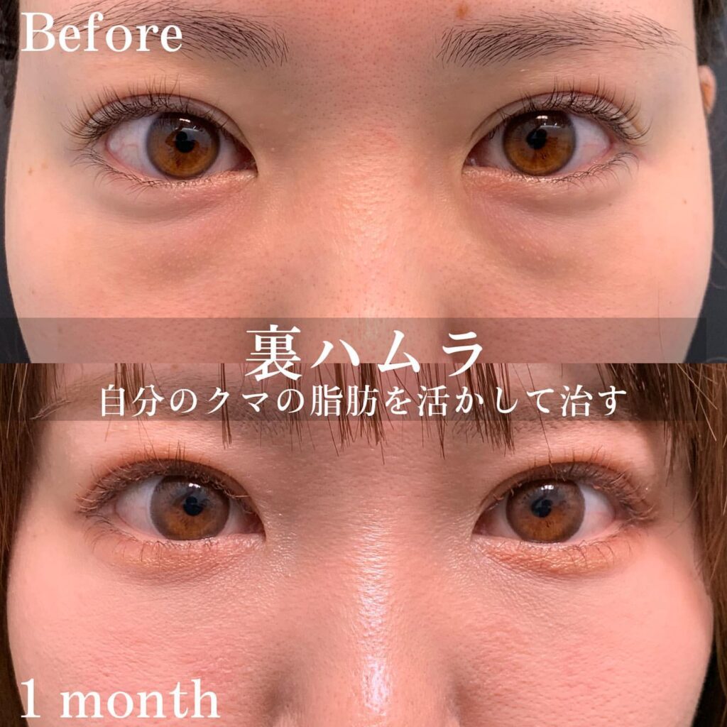 eクリニック-クマ取り症例写真