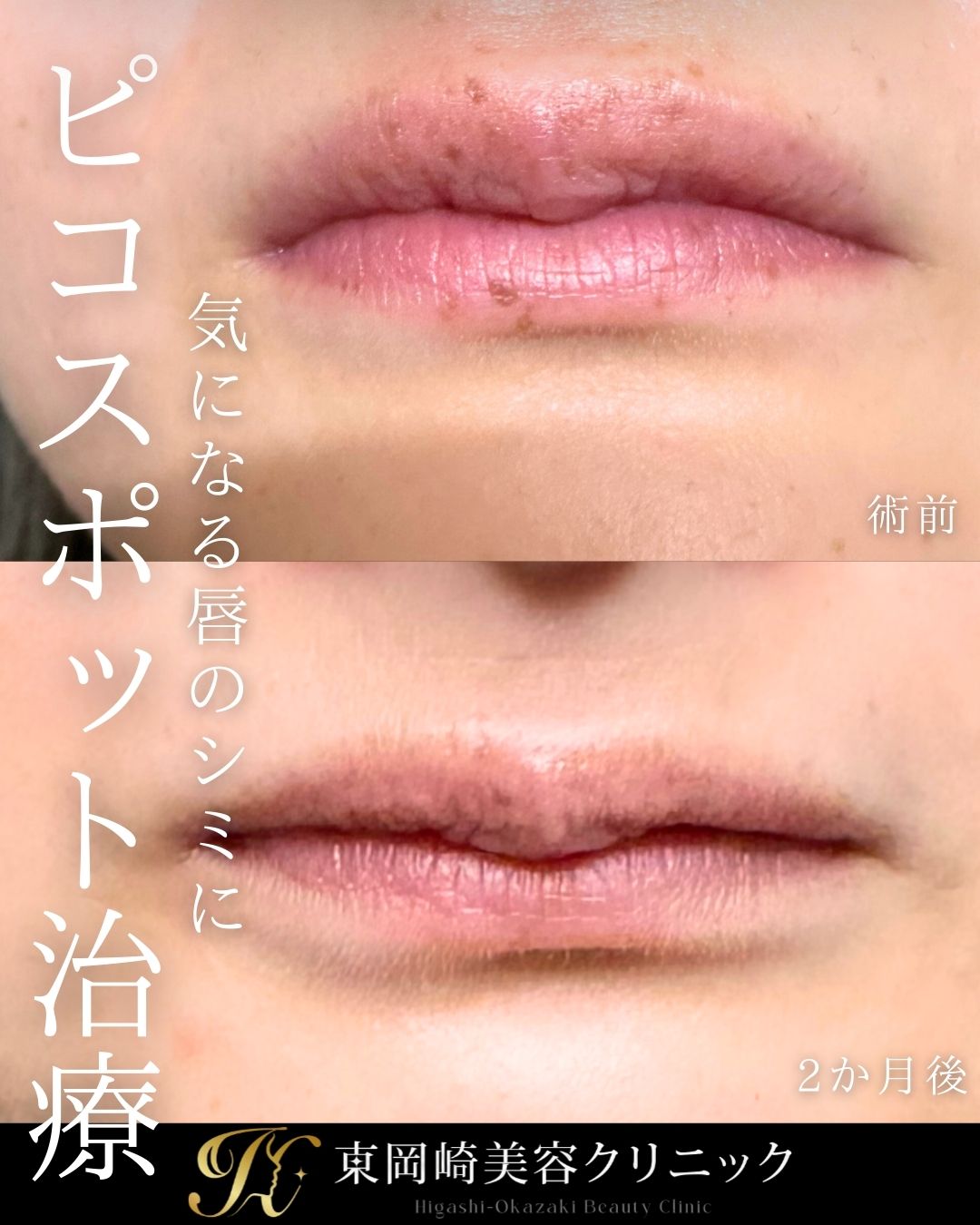 シミ取りスポット