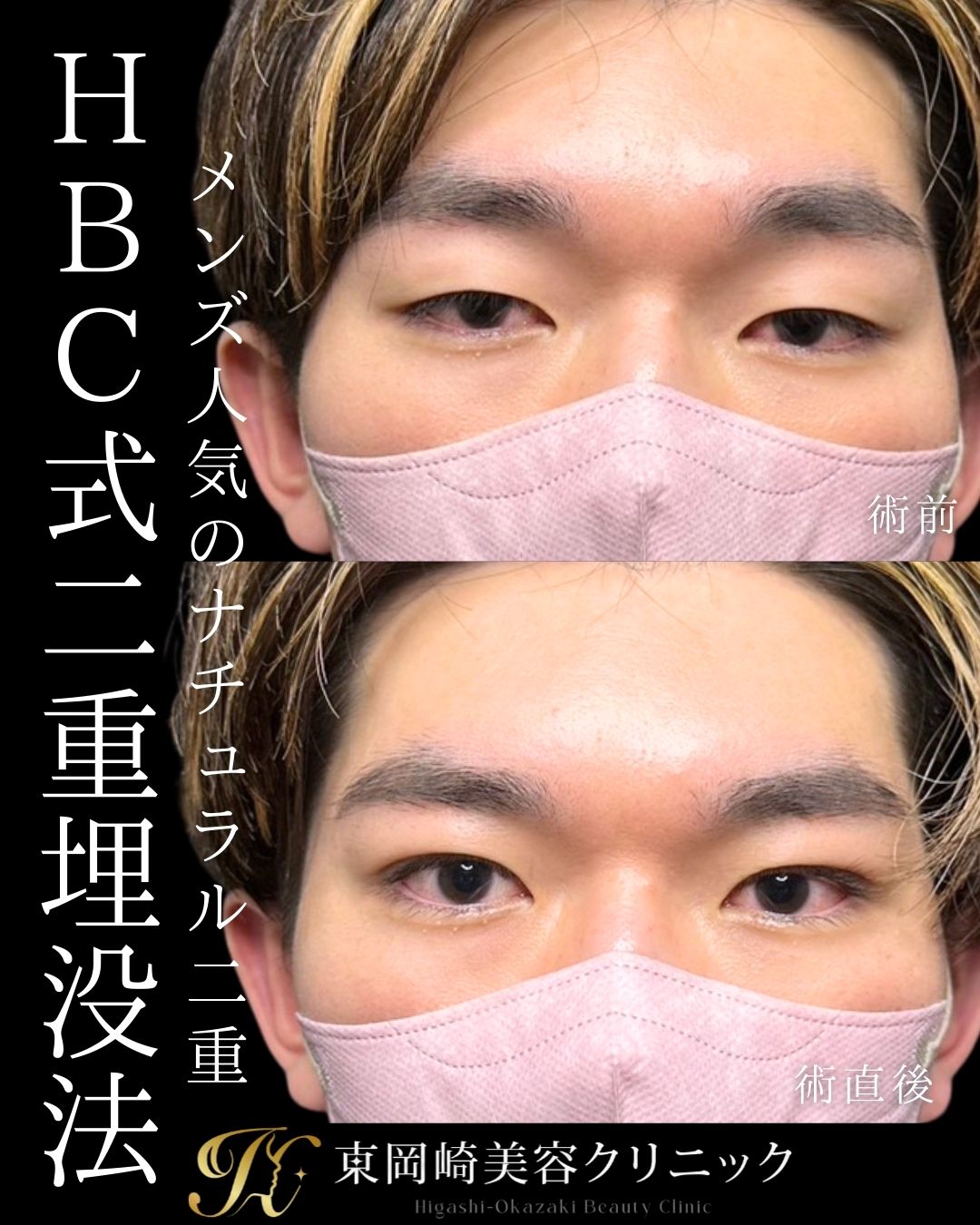 HBC式1dayプレミアムアイ（線留め）