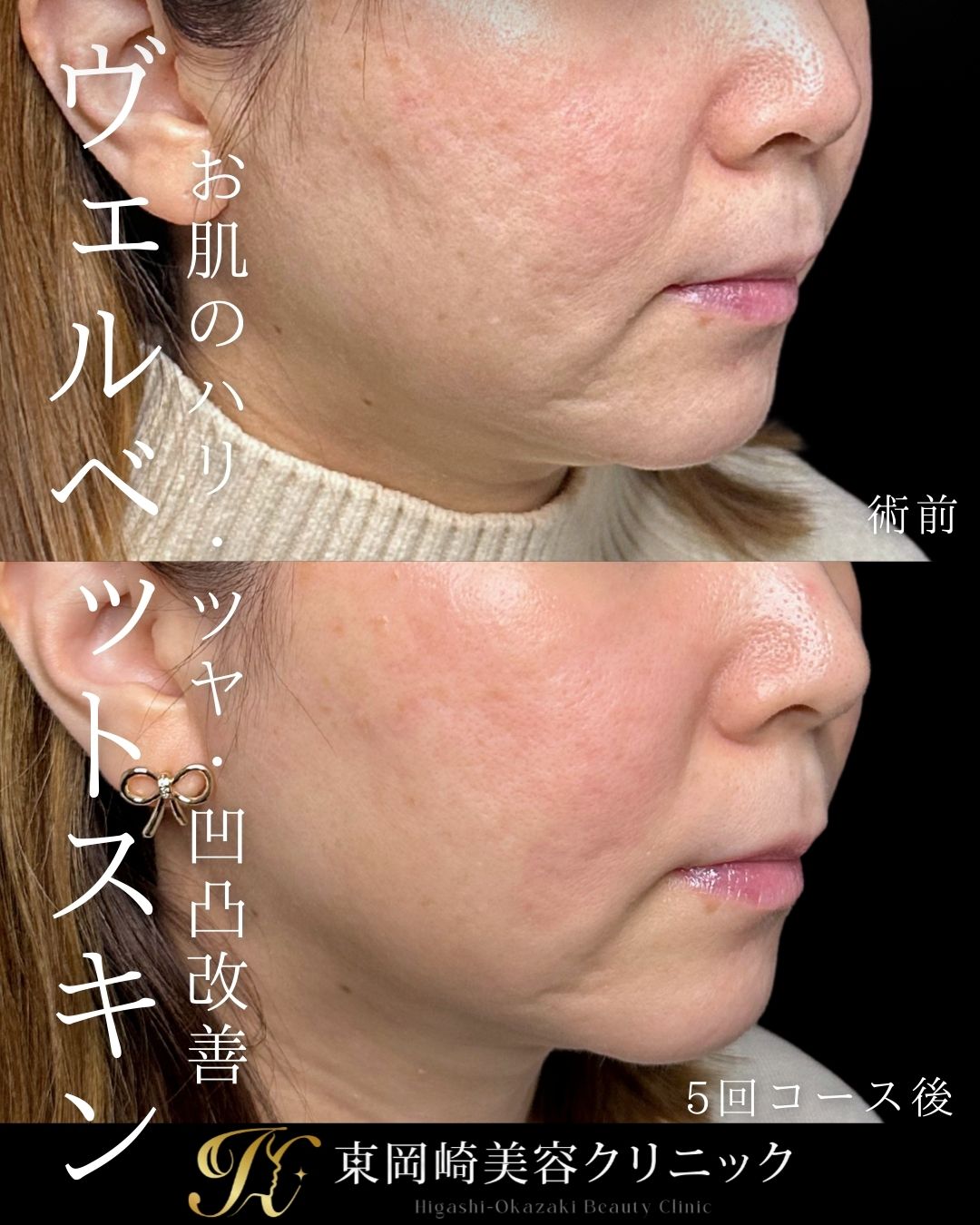 ヴェルベットスキン