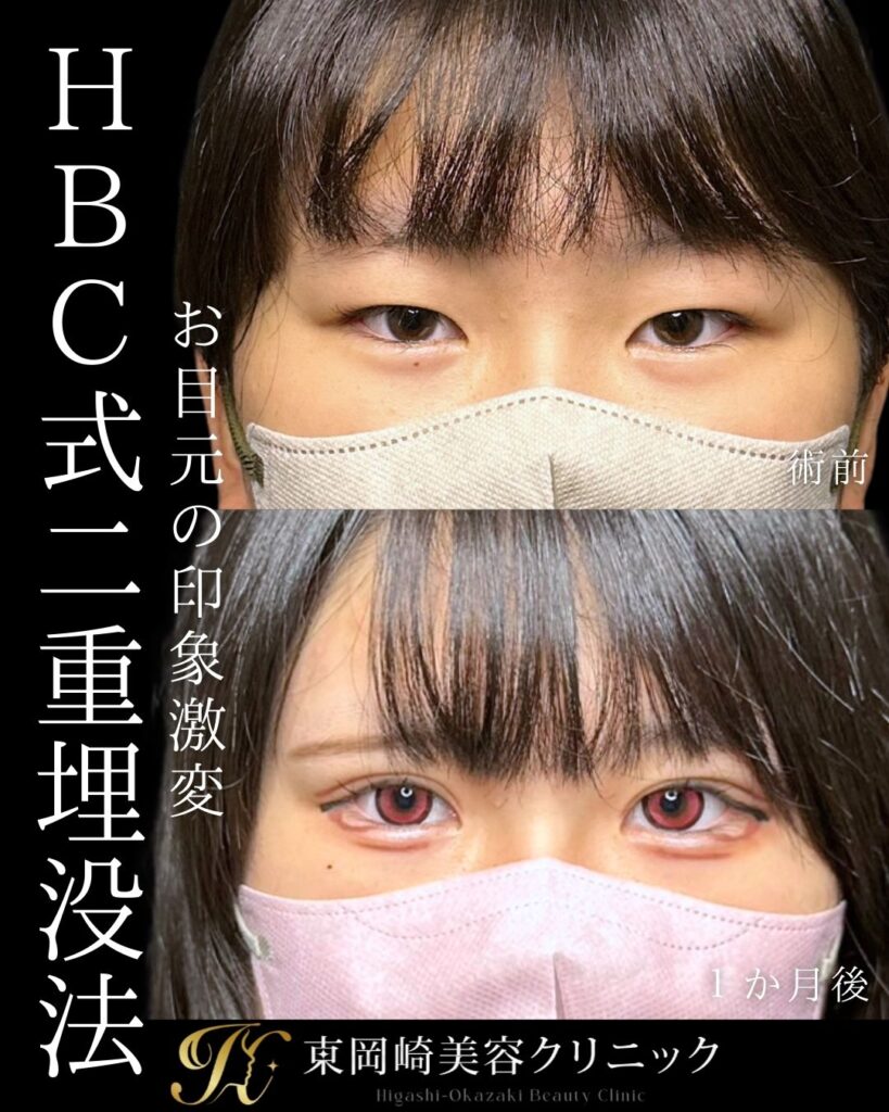 二重整形 埋没法 症例写真 東岡崎美容クリニック