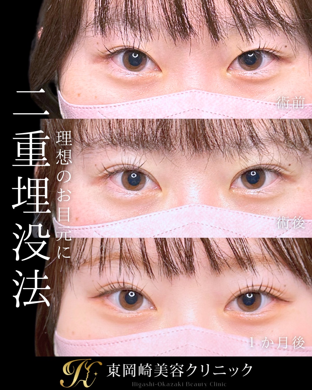 二重整形 埋没法 症例写真 東岡崎美容クリニック