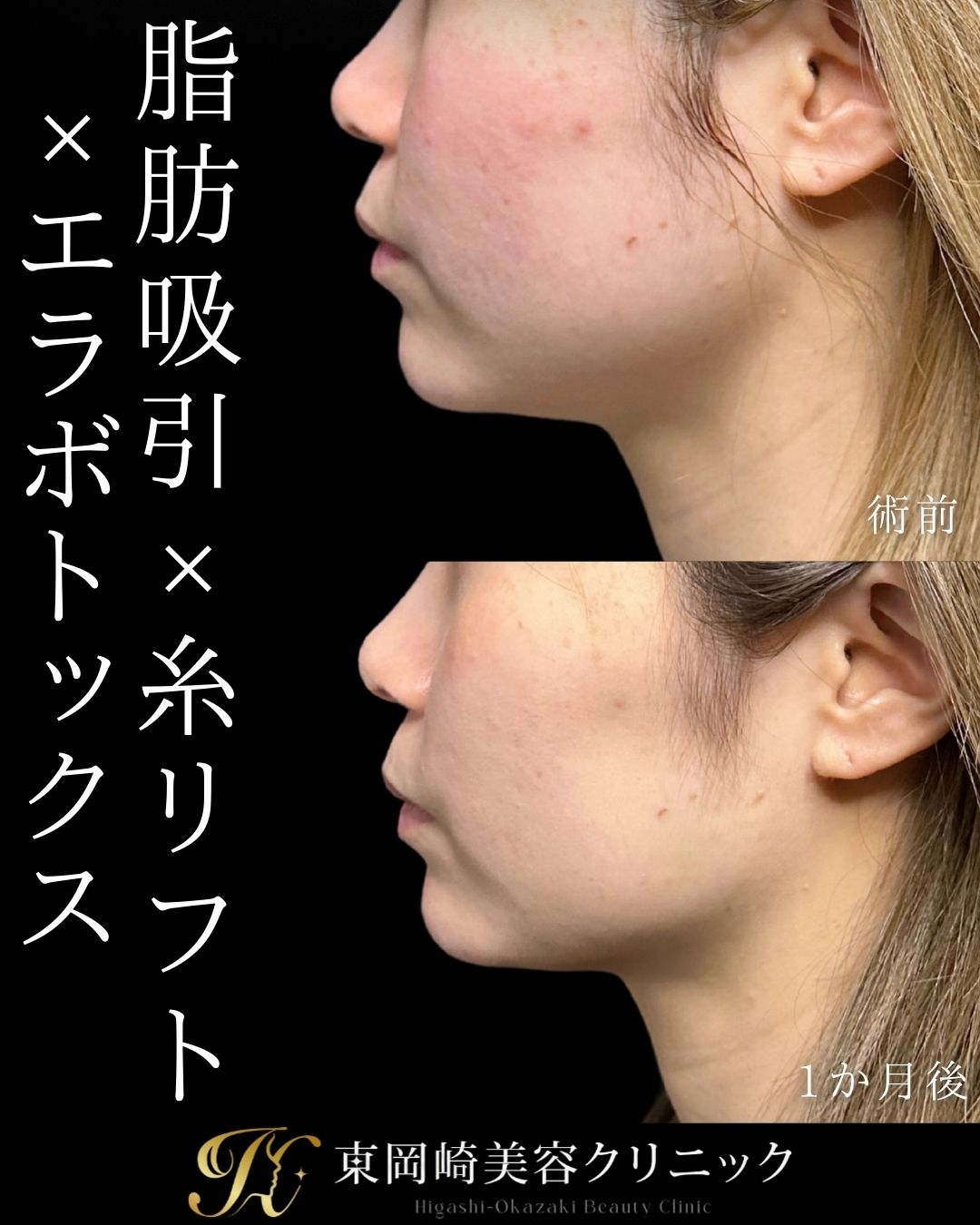 顎下脂肪吸引、糸リフト、ボツリヌストキシン注射