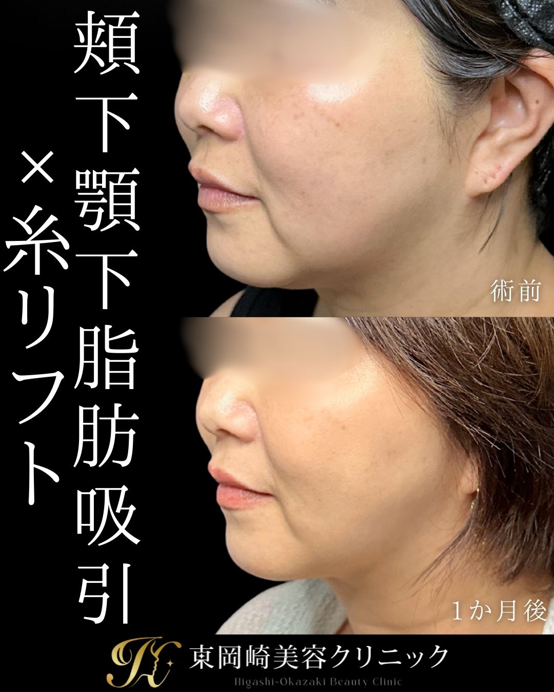 脂肪吸引（頬下・顎下）、糸リフト