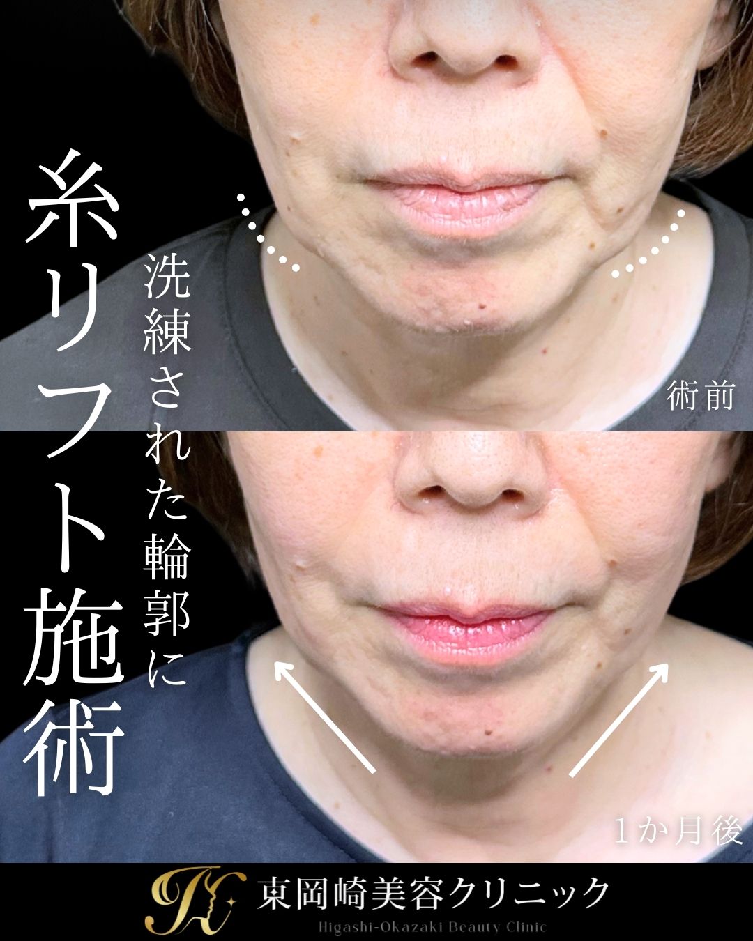 糸リフト、ヒアルロン酸（ほうれい線）